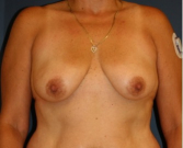 Feel Beautiful - Breast Augmentation 133 - Before Photo